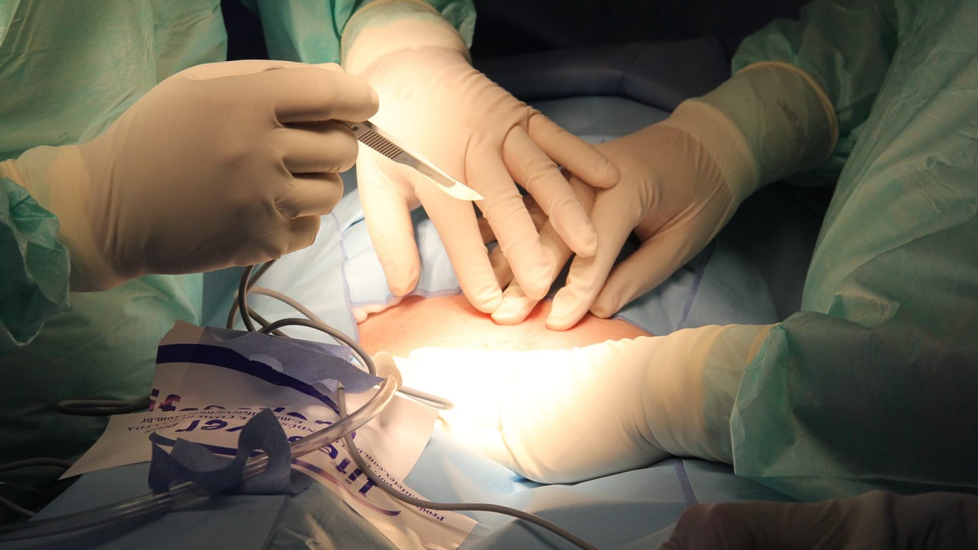 Professionnels de la santé effectuant une chirurgie de liposuccion avec des instruments de précision sous une lumière opératoire vive.