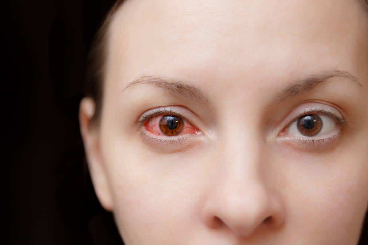 Gros plan d'une personne présentant un œil rouge irrité, présentant éventuellement des symptômes de conjonctivite.