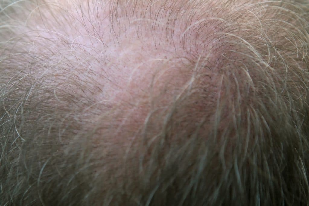 Qu’est-ce qu’une greffe de cheveux ?