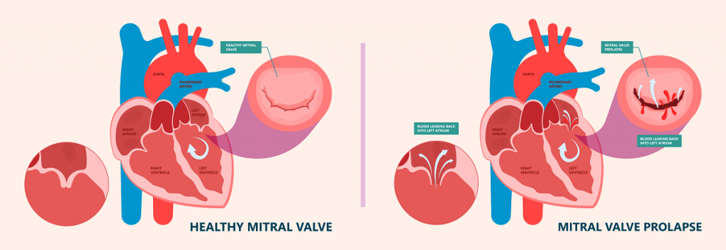 Comment détecter un prolapsus de la valve mitrale ?