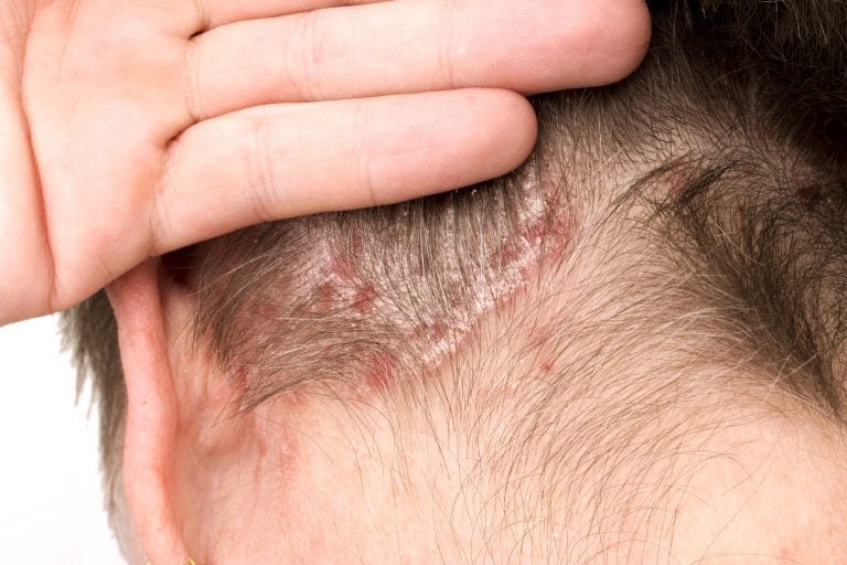 Comment soulager le psoriasis du cuir chevelu ?