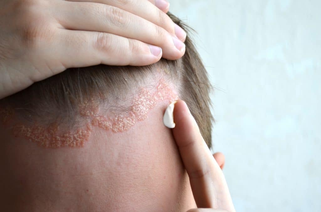 Comment traiter le psoriasis du cuir chevelu ?