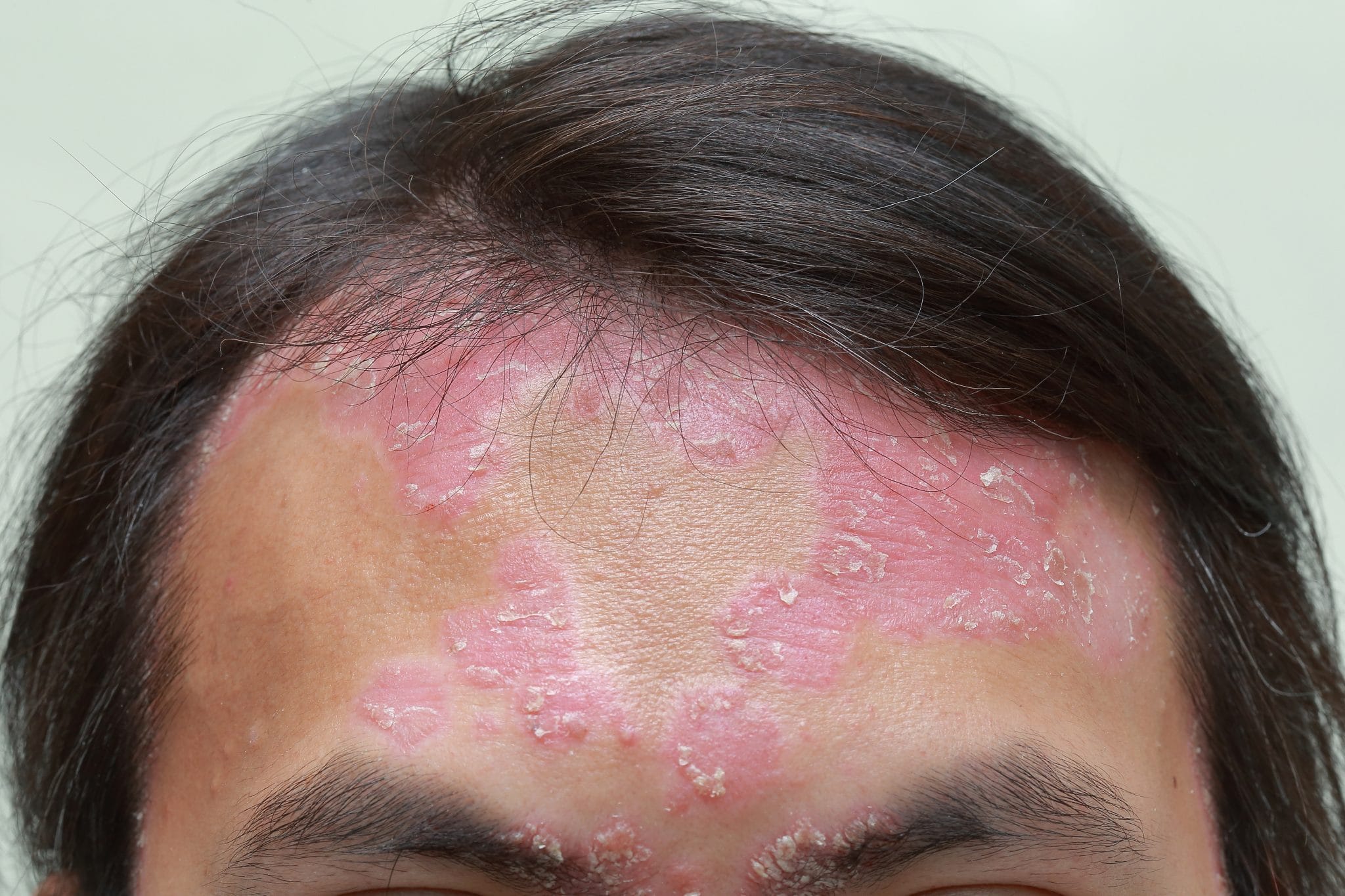 Comment se caractérise le psoriasis du visage ?