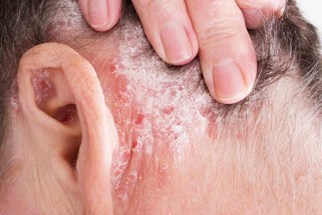 Comment reconnaitre le psoriasis du cuir chevelu ?