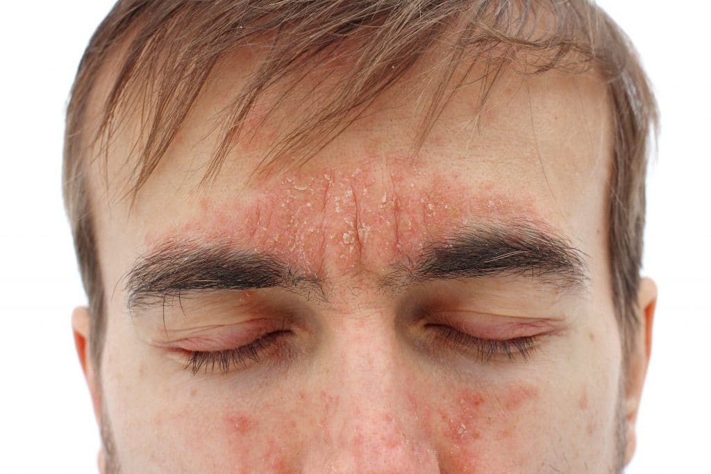 Comment reconnaître le psoriasis du visage ? 