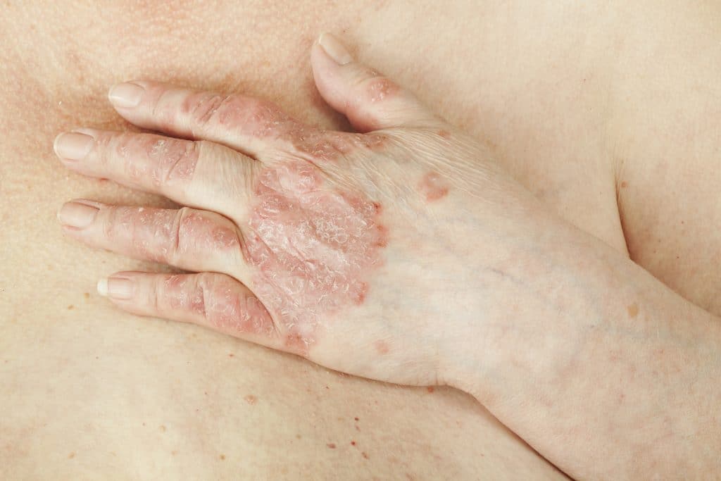 Le psoriasis des mains : comment le reconnaître ?