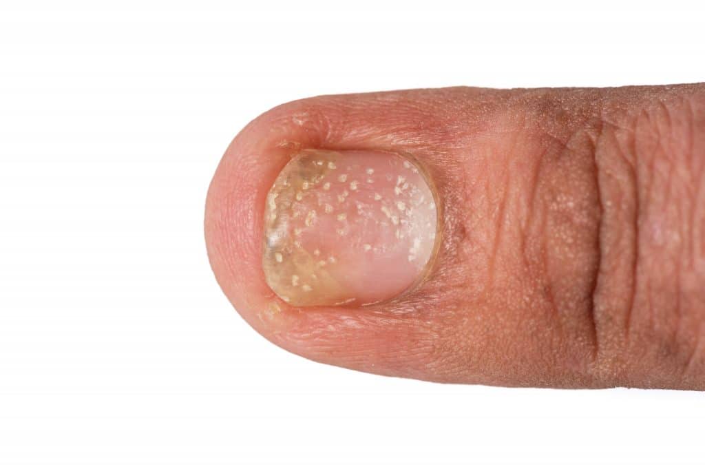 Qu'est-ce que le psoriasis de l'ongle ?