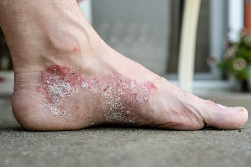 Comment soigner le psoriasis des pieds ?  