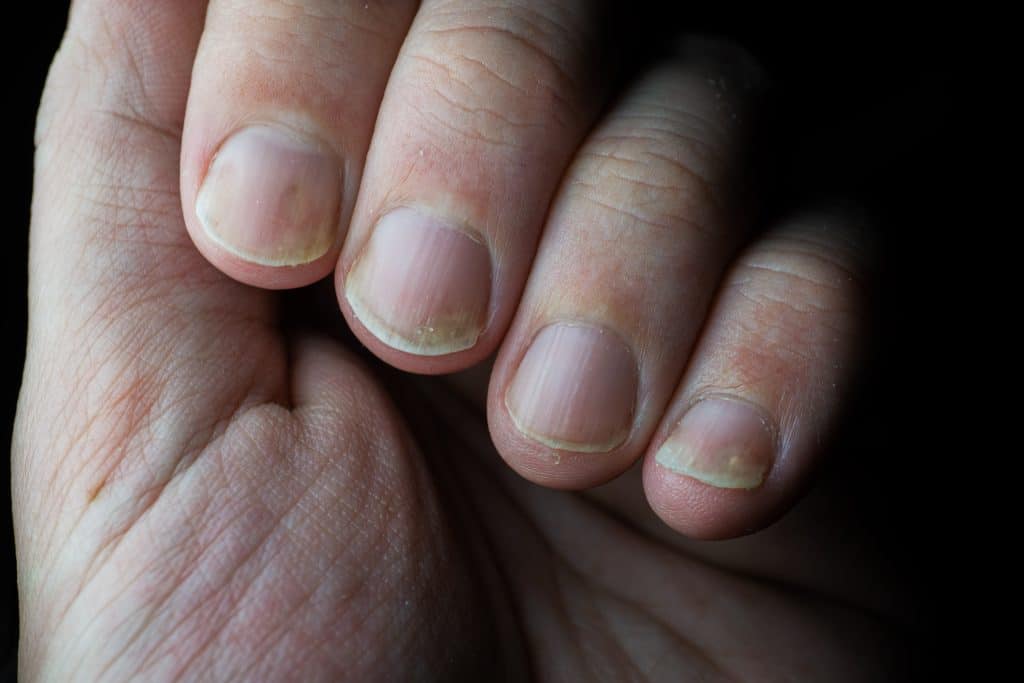 Comment soigner le psoriasis des ongles ?