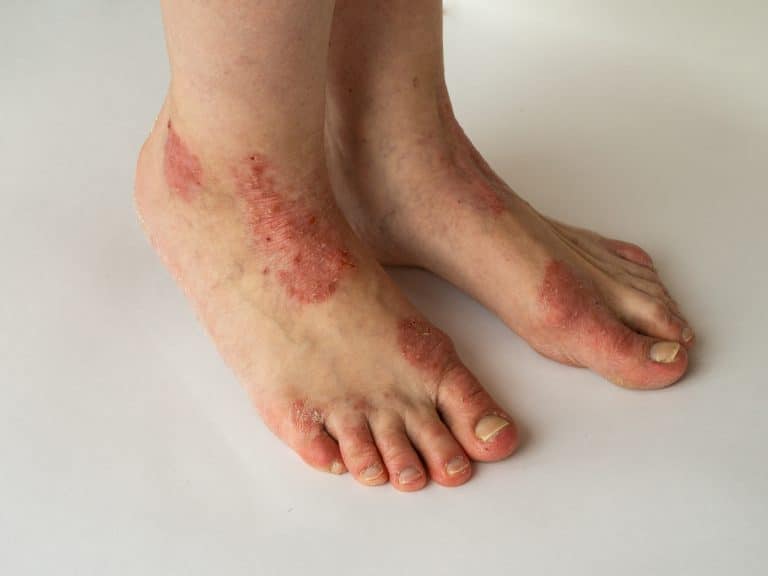 Psoriasis du pied : quels signaux d’alerte ?