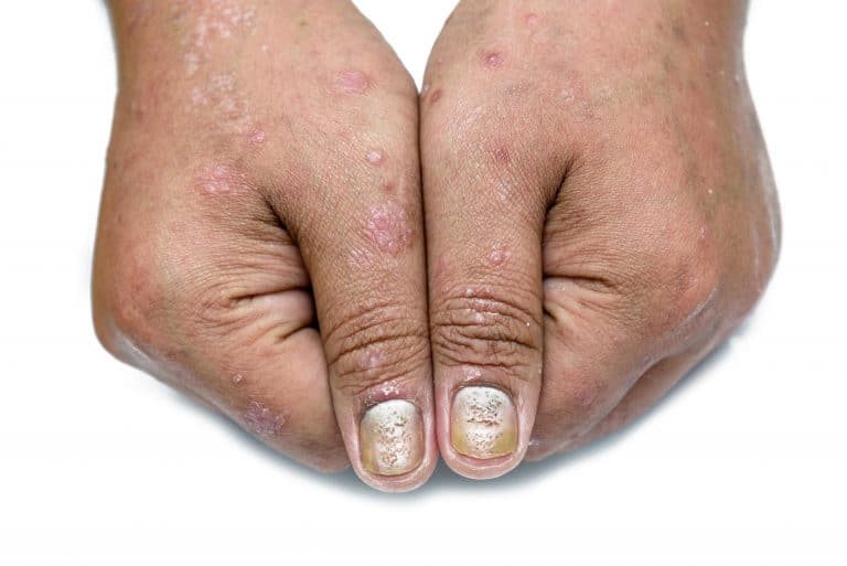 Comment traiter le psoriasis des ongles ?