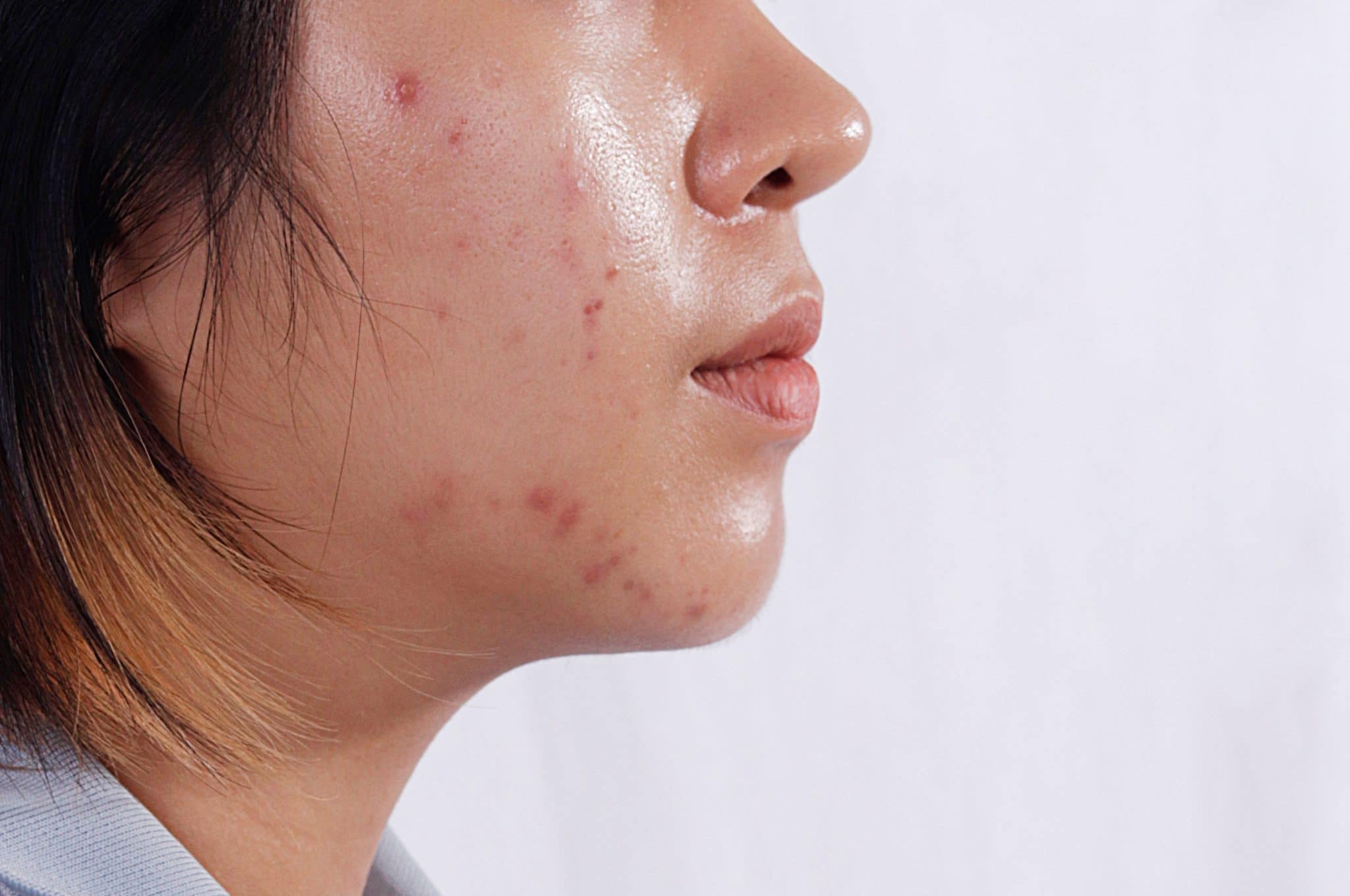 Gros plan du profil d'une femme mettant en évidence un traitement hormonal contre l'acné sur sa joue.