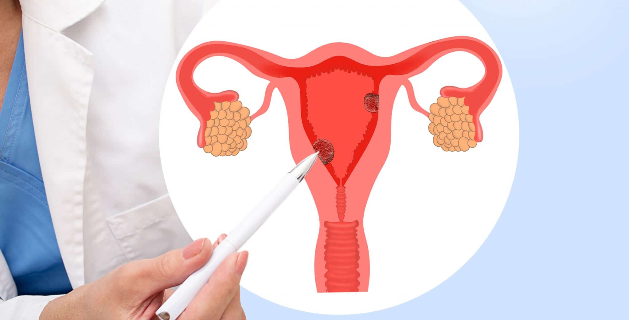 Un professionnel de la santé montre un schéma d'un système reproducteur féminin mettant en évidence les ovaires, l'utérus et les traitements potentiels contre la polype utérine.