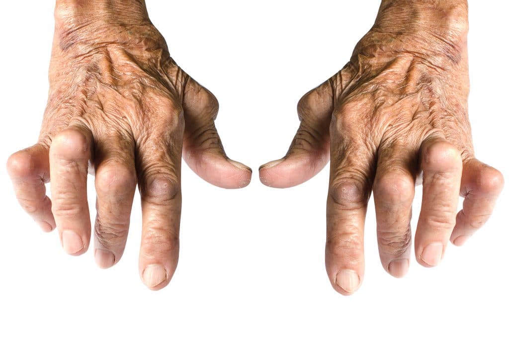 L’arthrite : c’est quoi ?