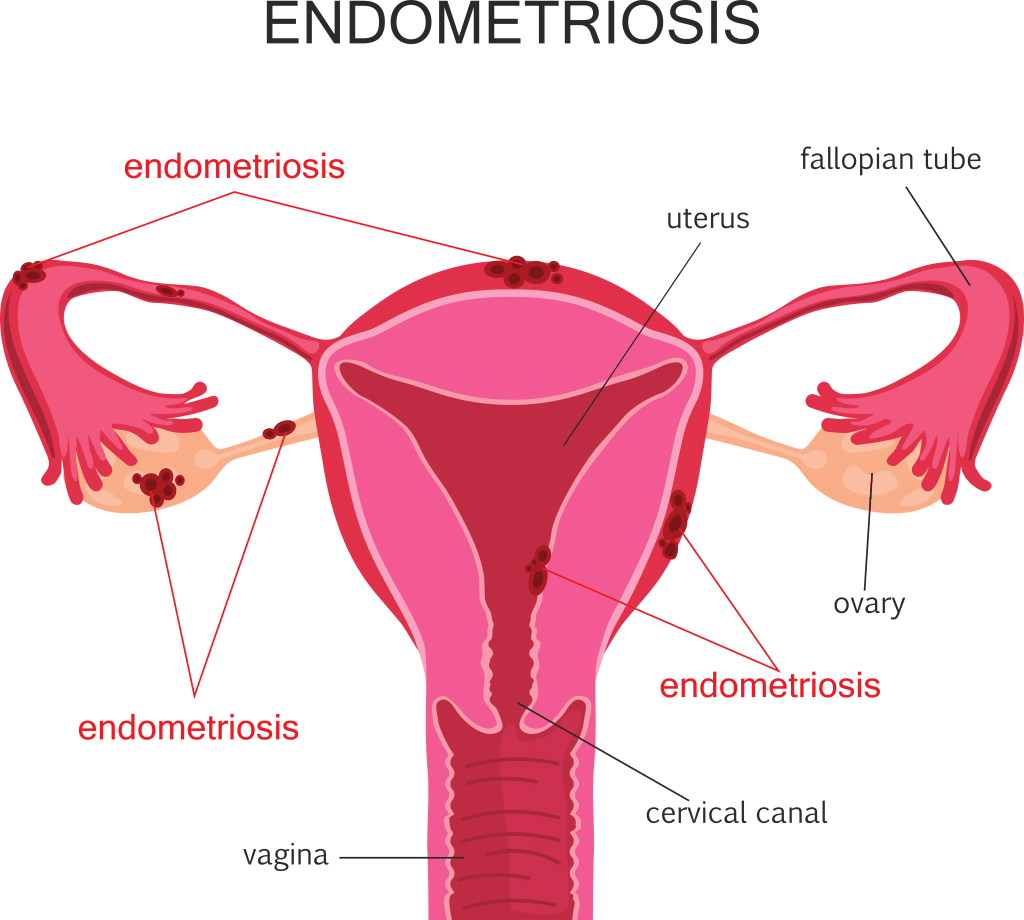 Qu’est-ce qui déclenche l’endométriose ?