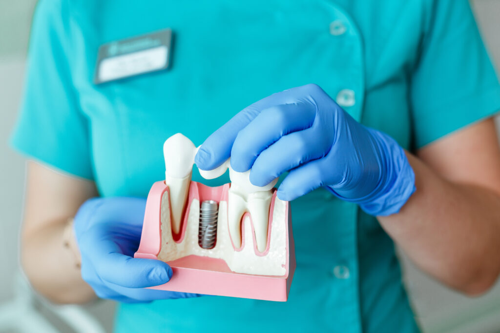 Implantologie dentaire : qu’est-ce que c’est ?
