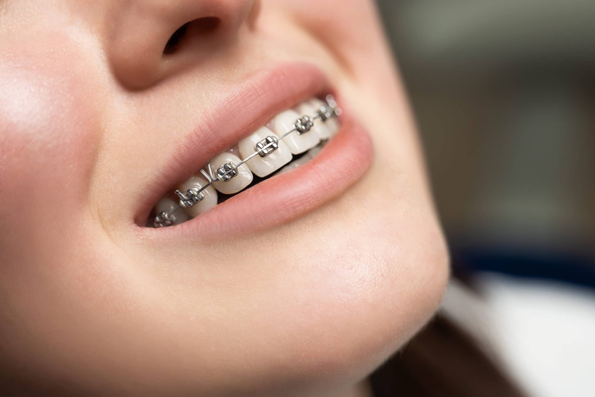 Orthodontie : quels sont les différents traitements ?