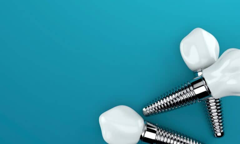 Qu’est-ce que l’implantologie dentaire ?