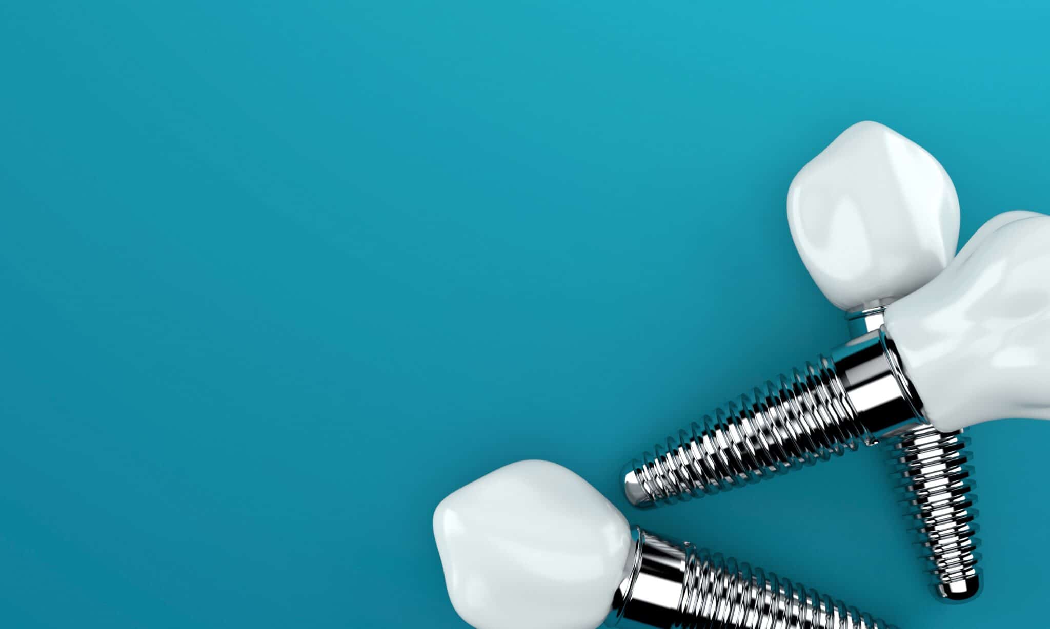 Qu'est-ce que l'implantologie dentaire ?