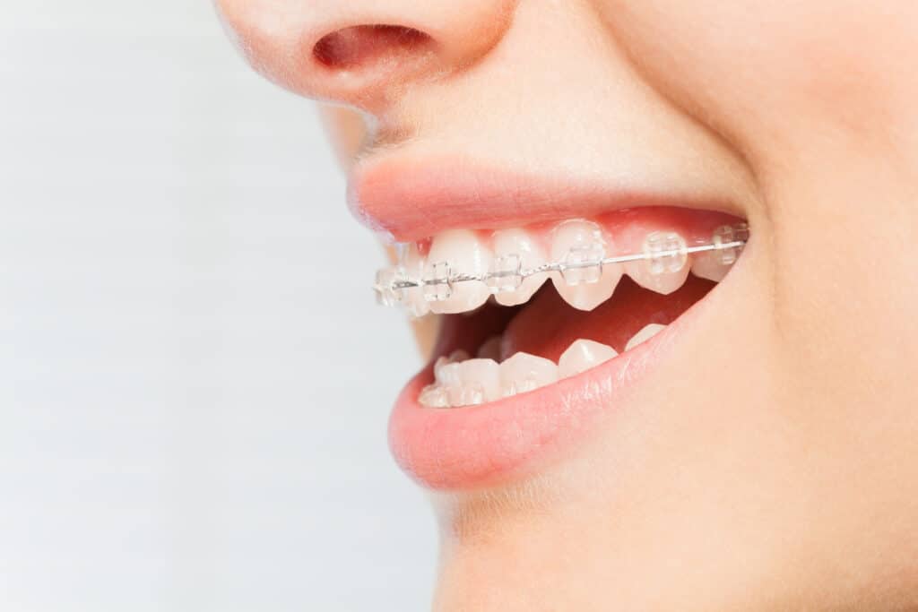L'orthodontie : qu'est-ce que c'est ?