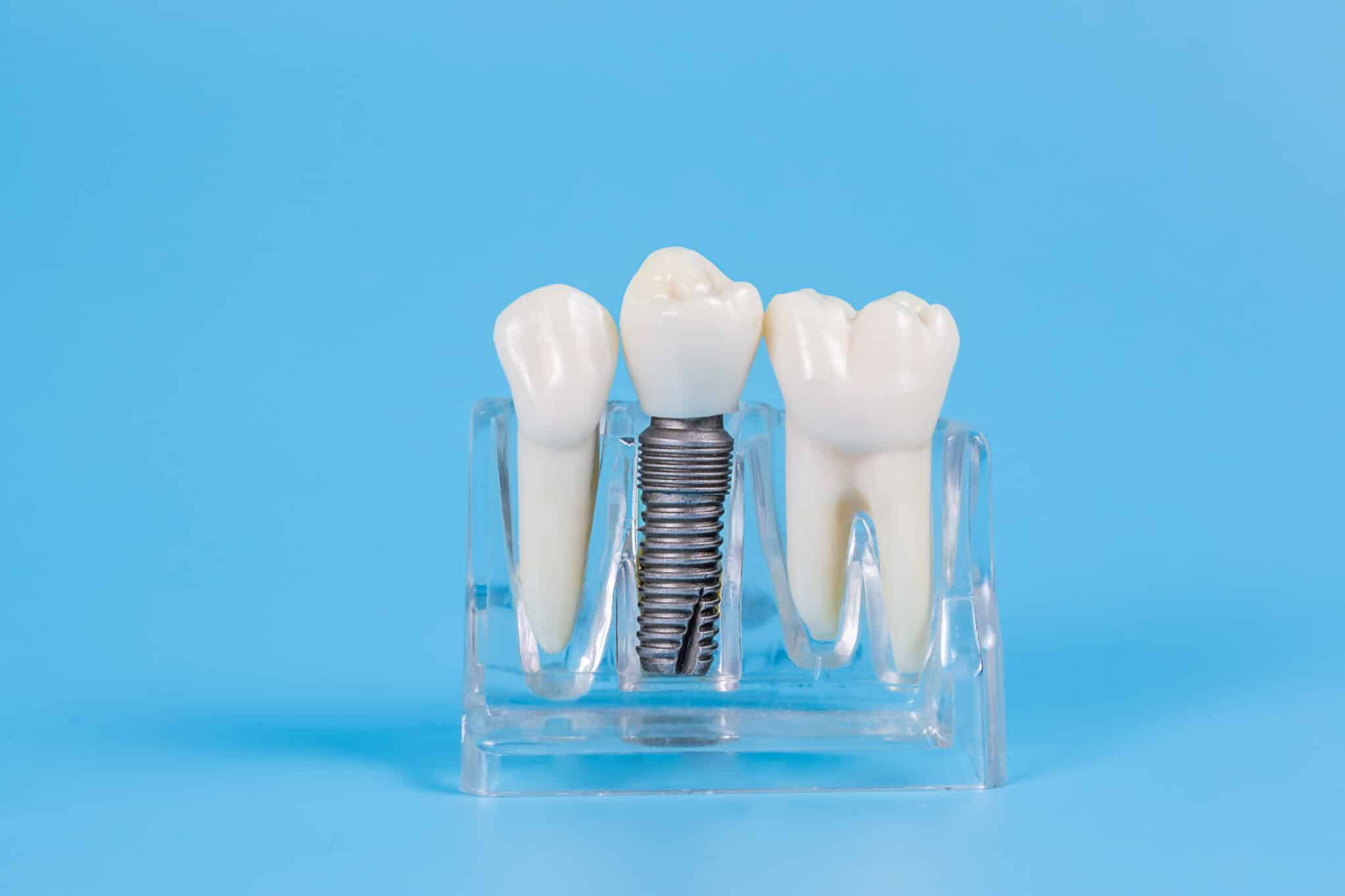 Est-ce douloureux de se faire poser un implant dentaire ?