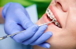 Qu'est-ce qu'un appareil orthodontique ?