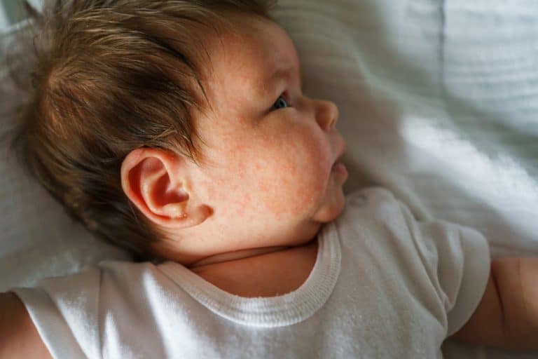 Options de traitement pour l’eczéma atopique chez les bébés : recommandations et précautions