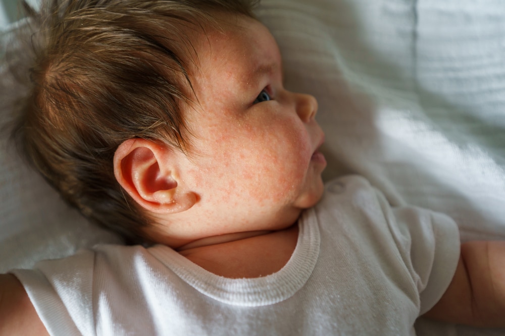 Options de traitement pour l'eczéma atopique chez les bébés : recommandations et précautions