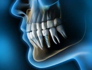 Cahier des charges de la pose d’implant dentaire : avez-vous le bon profil ?