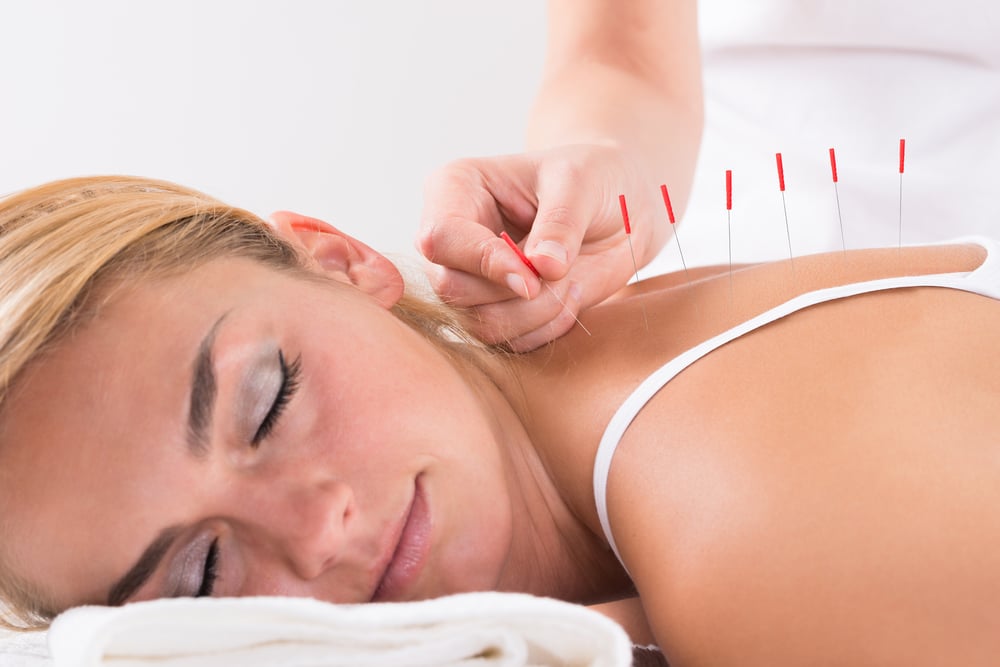 Tout savoir sur l'acupuncture : définition et principe d'une femme recevant un traitement d'acupuncture.