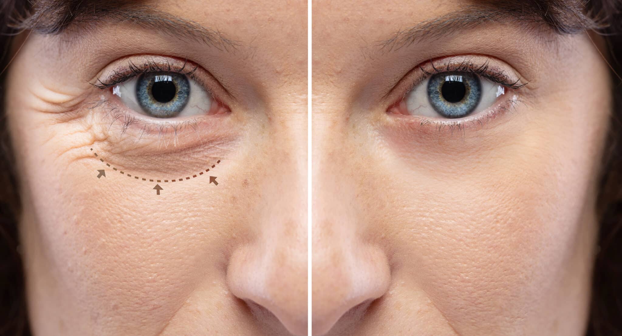 Les yeux d'une femme avant et après une intervention chirurgicale.
